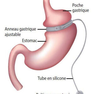Anneau gastrique virtuel